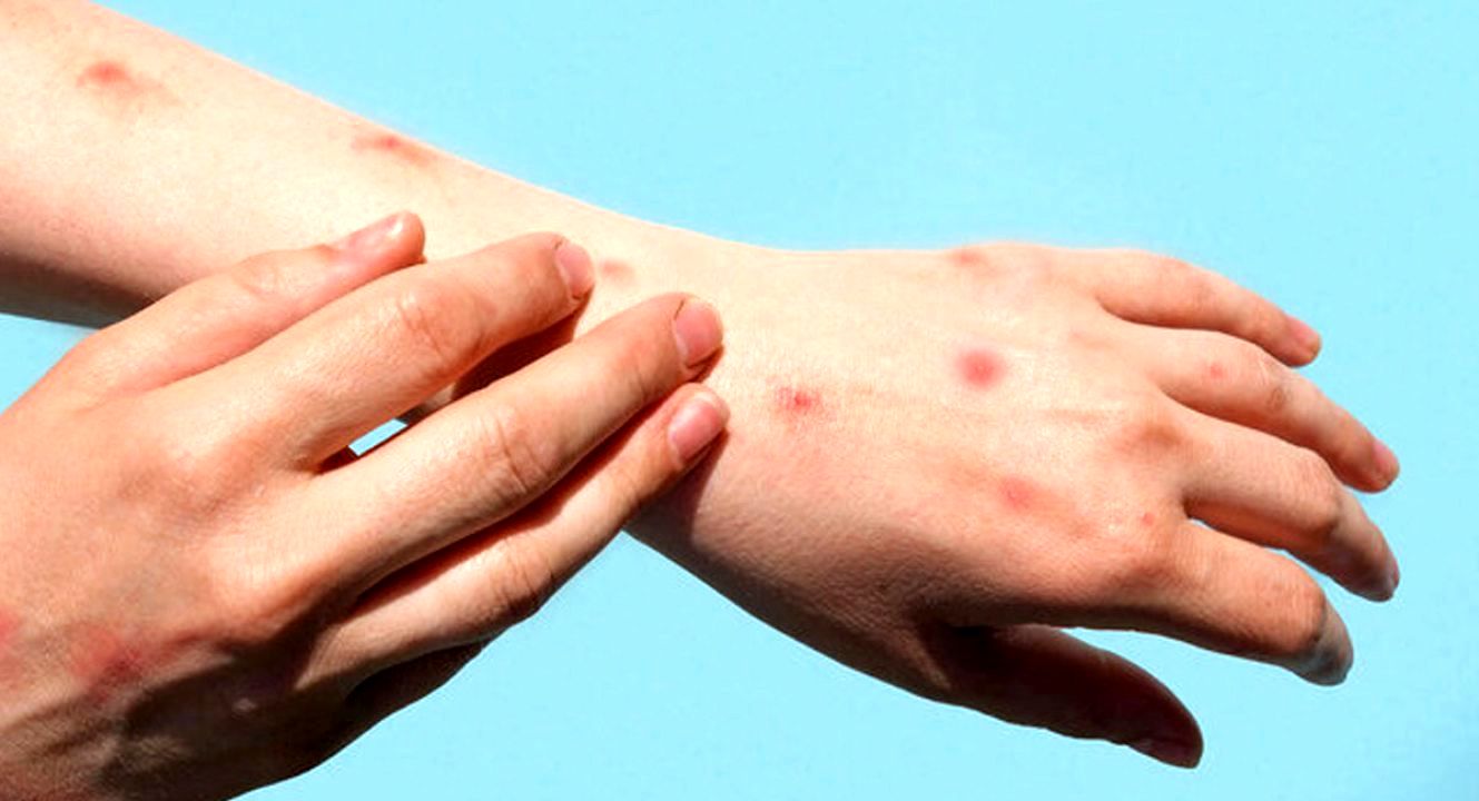 برای پیشگیری از ابتلا به بیماری آبله میمون باید چه کرد؟