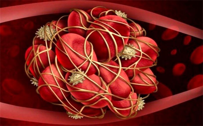 لخته‌ خون؛ از علائم تا عوارض