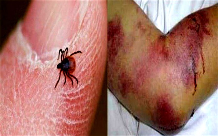 گرما و آغاز فعالیت کنه‌ها