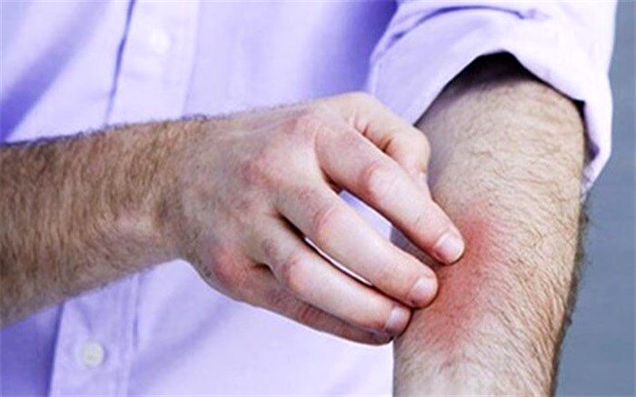 نشانه‌های پوستی کووید-۱۹