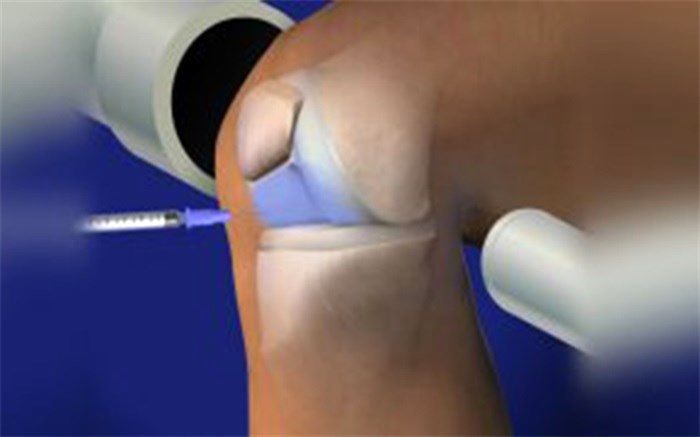 هر آنچه باید درباره اوزون درمانی بدانیم