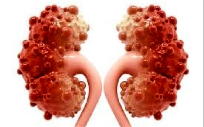 علائم مشکلات کلیوی ناشی از کرونا