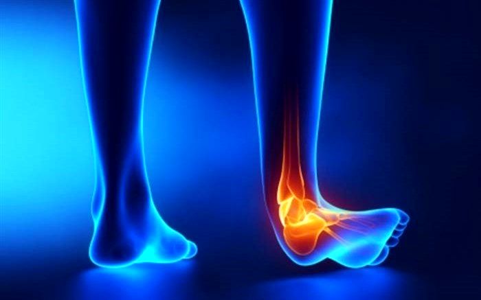 درد ناگهانی عضله مچ پا نشانه کرونا نیست