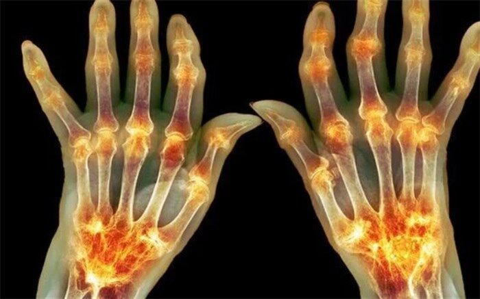 یک درصد از مبتلایان به کرونا دچار التهاب مفصلی و ورم مفاصل می‌شوند