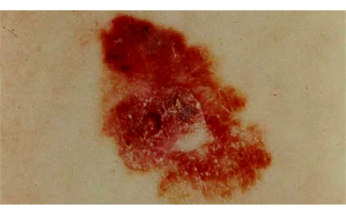 بررسی سرطان بدخیم پوست با کمک یک مولکول در ادرار!