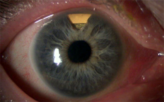 بیماری «آب سیاه» را جدی بگیرید