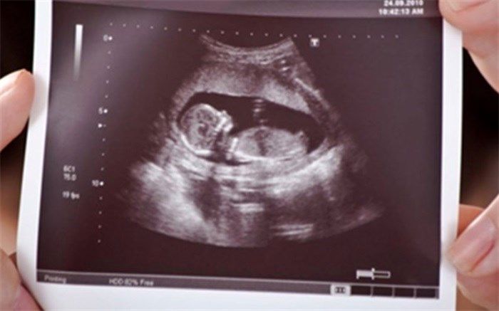 اختیاری‌شدن غربالگری جنین ؛ یک درصدِ پر استرس