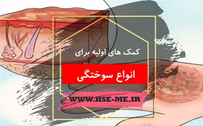 کمک‌های اولیه برای مصدوم دچار سوختگی+اینفوگرافیک