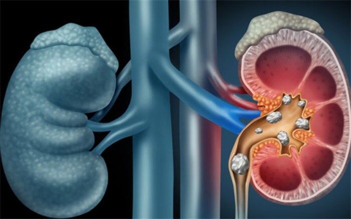 چند توصیه پزشکی درباره کلیه‌ها