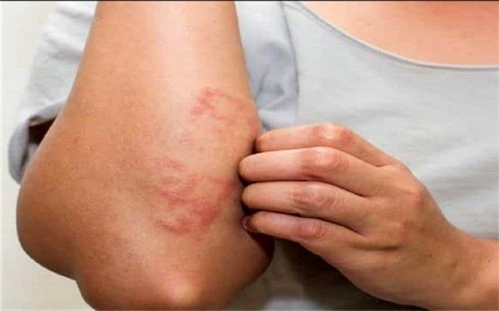 ۹ ماده غذایی  که باعث خارش می‌شود