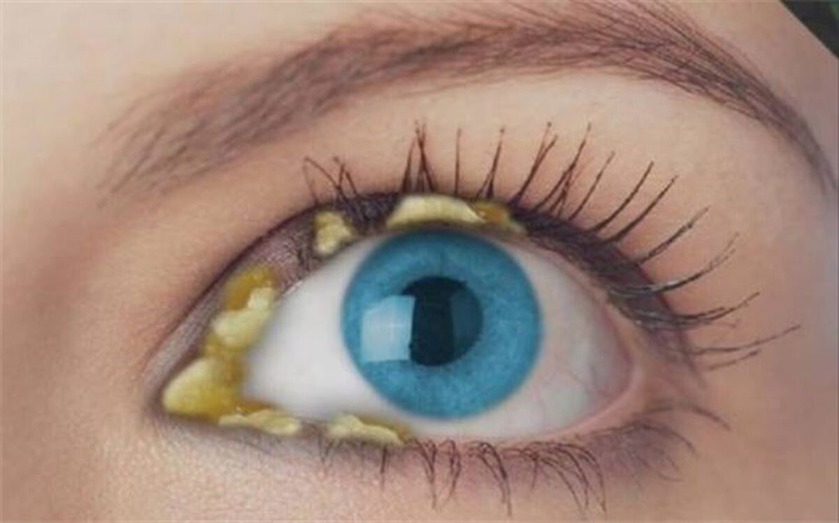 آنچه ترشحات چشم درباره سلامتی می‌گوید