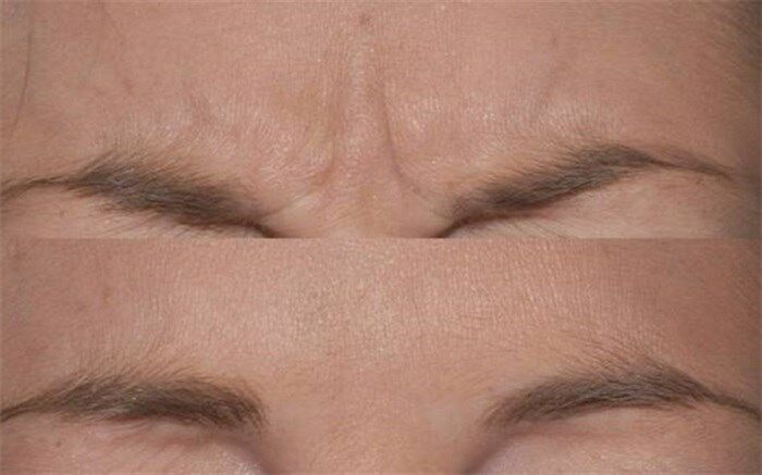 راهکارهای طبیعی برای از بین بردن خط اخم