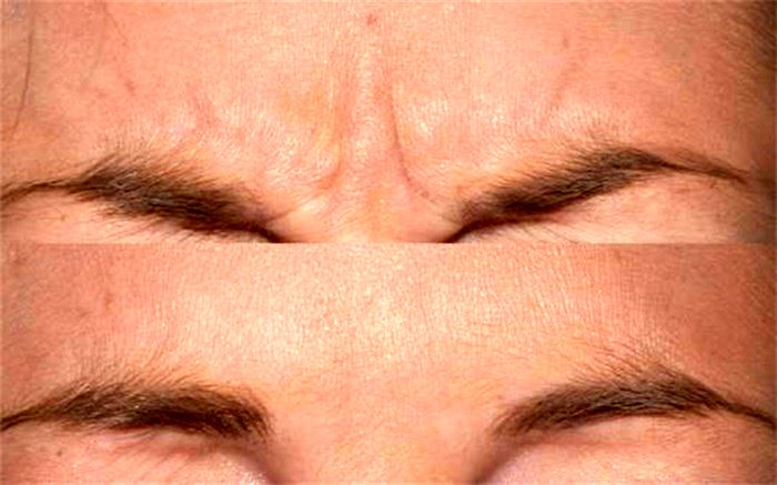 راهکارهای طبیعی برای از بین بردن خط اخم