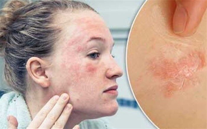 چگونه عارضه اگزمای صورت را شناسایی کنیم؟+اینفوگرافیک