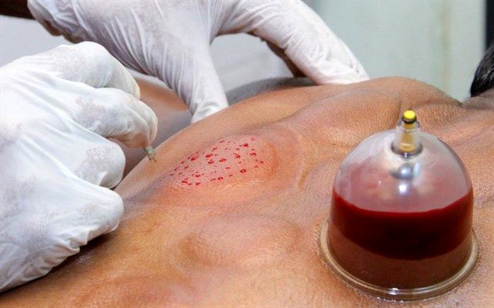 حجامت باعث تقویت سیستم ایمنی بدن می شود