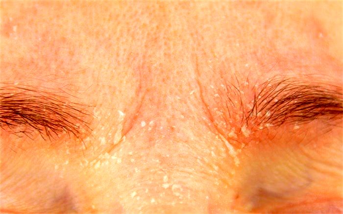 شوره ابرو چیست و چه باید کرد؟