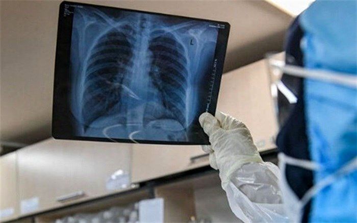 علائم درگیری ریه در مبتلایان کرونا چیست؟