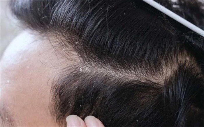 دلیل اصلی شوره سر چیست؟