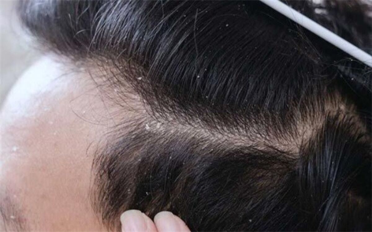 دلیل اصلی شوره سر چیست؟