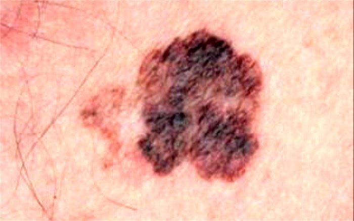 کدام خال‌ها نشانه سرطان  است؟