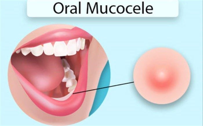 موکوسل دهانی چیست ؟