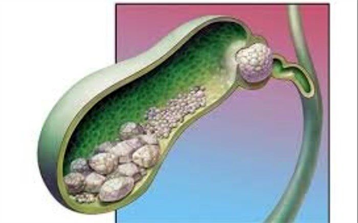 درمان سنگ صفرا چگونه انجام می‌شود؟