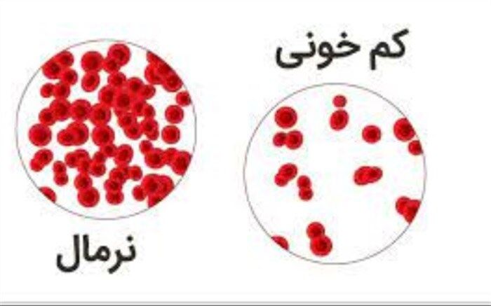 کم خونی روی سرگیجه تاثیر دارد؟
