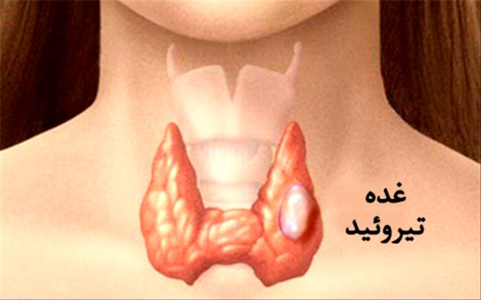 علائم سرطان تیروئید