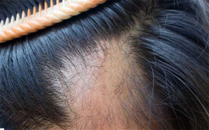 افسردگی می‌تواند موجب ریزش مو شود؟