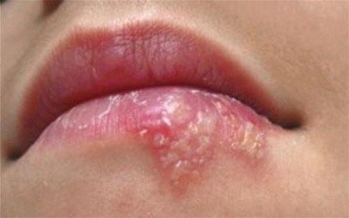 چگونه با کمک طب ایرانی در خونه تبخال رو درمان کنیم؟/فیلم