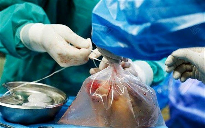 اعضای بانوی اردبیلی نجاتگر بیماران نیازمند شد