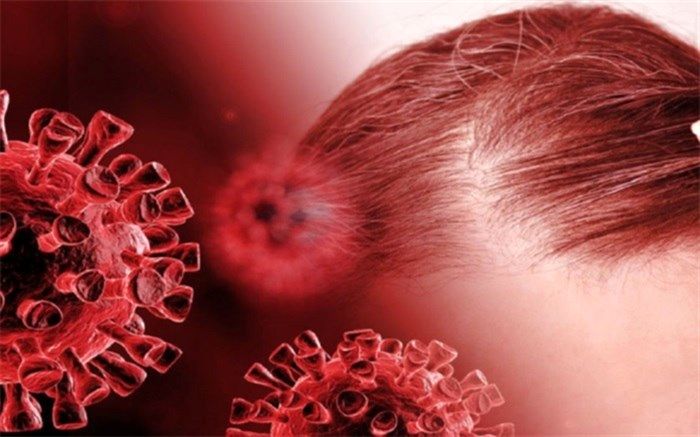 ریزش موی ناشی از کرونا دائمی است؟