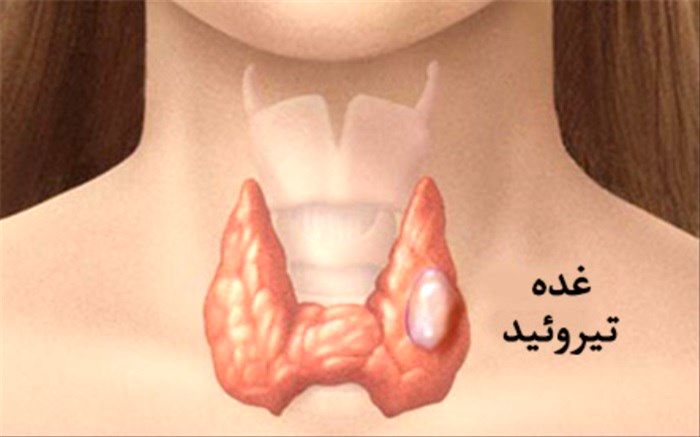 هر آنچه باید درباره گره تیروئید بدانید