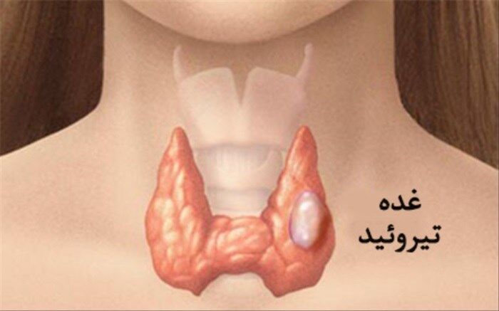 هر آنچه باید درباره گره تیروئید بدانید