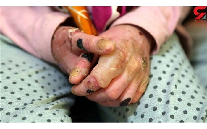 محموله اهدایی پانسمان بیماران پروانه‌ای مفقود نشده است