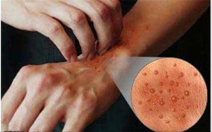 بیماری پوستی شایع ایرانیان چگونه درمان می‌شود؟