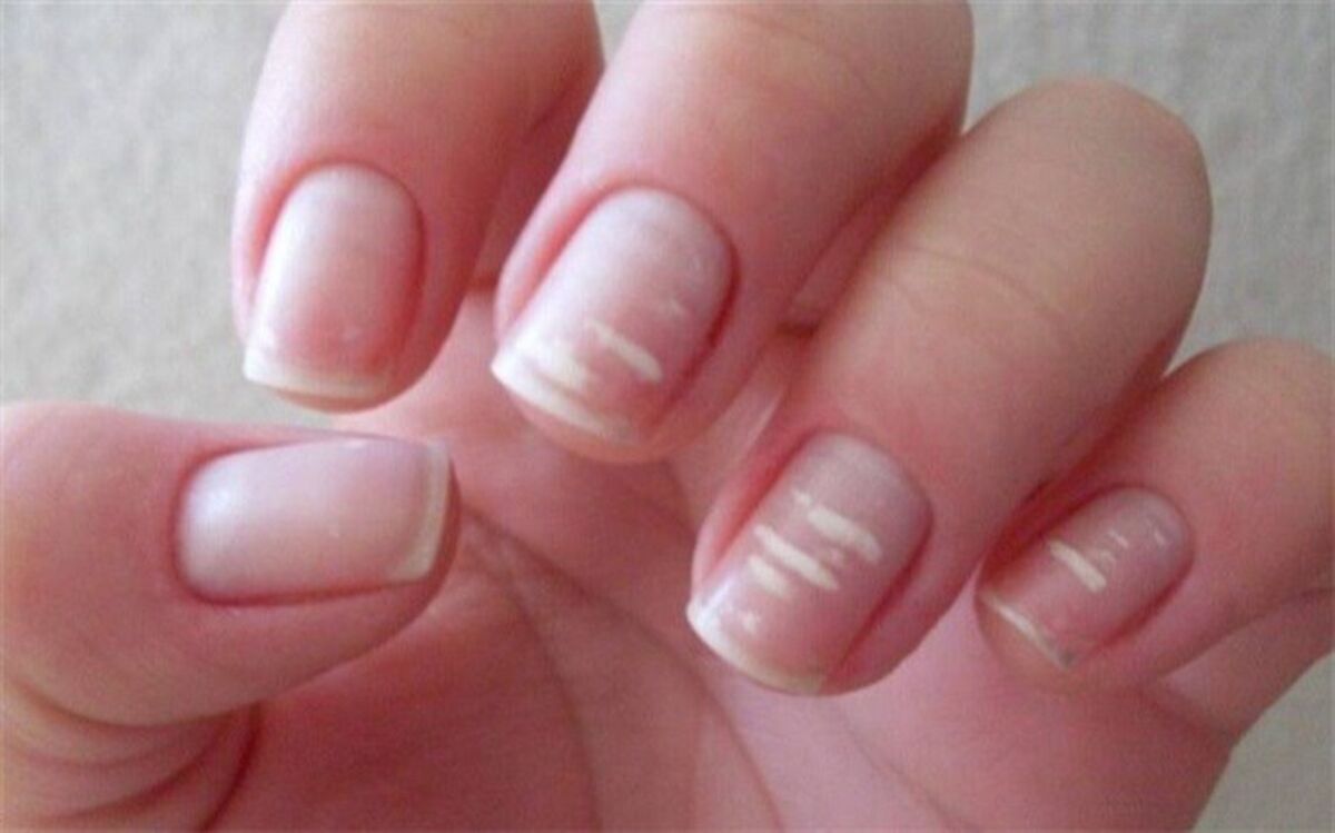 10 نشانه‌ کمبود کلسیم در بدن