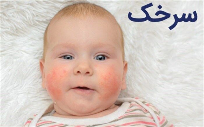 شناسایی دو مورد سرخک در استان یزد