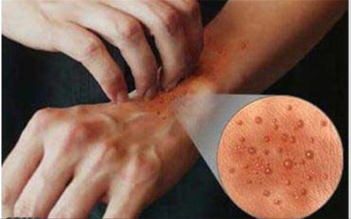 چرا اگزما با استرس تشدید می شود