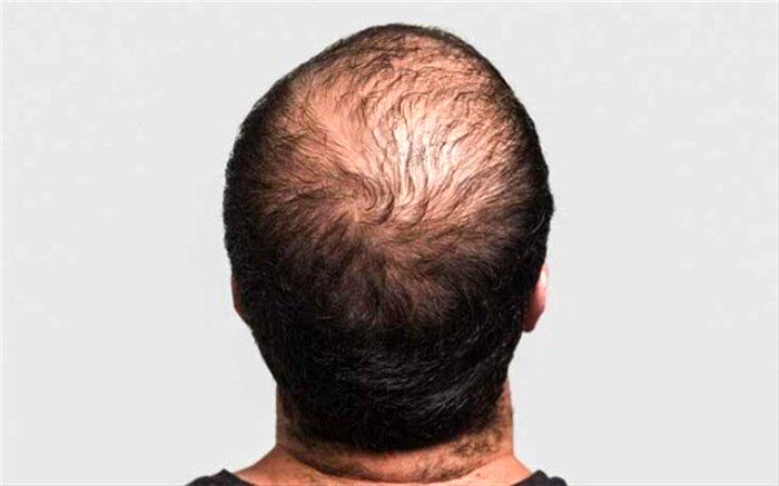 با این روش‌ها از ریزش مو جلوگیری کنید