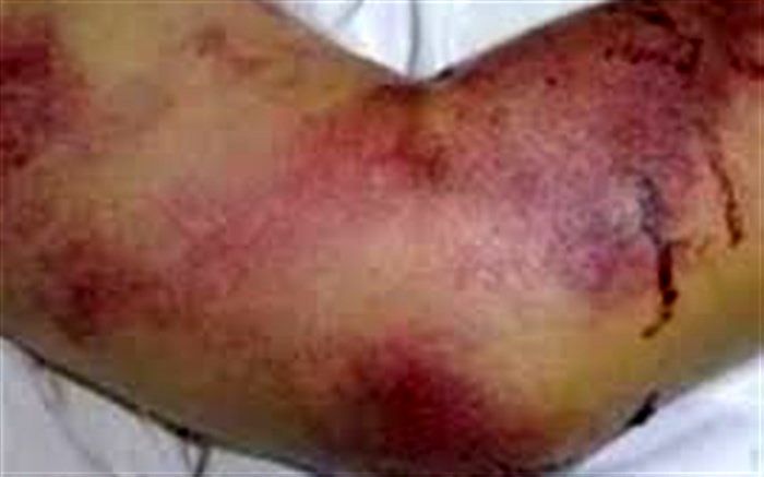 شناسایی ۳ بیمار مبتلا به تب کریمه کنگو در کشور