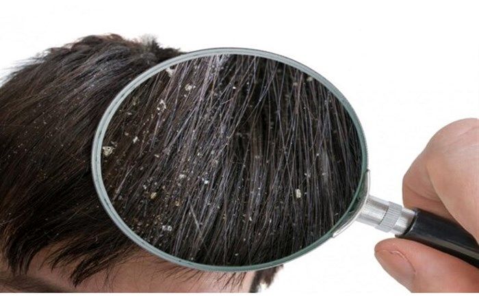 شوره سر خود را با این ماده ساده از بین ببرید