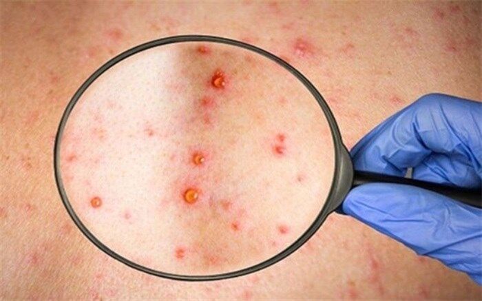 احتمال افزایش موارد ابتلا به آبله میمون در تابستان