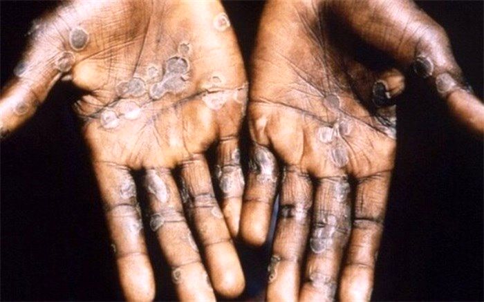 شناسایی بیش از ۱۰۰۰ مورد آبله میمونی در ۲۹ کشور