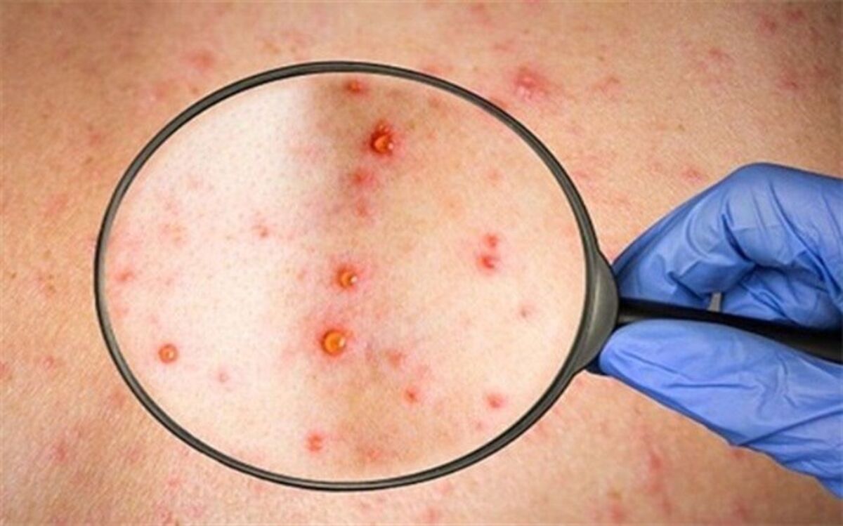 پاسخ به ۷ سوال مهم درباره آبله میمون