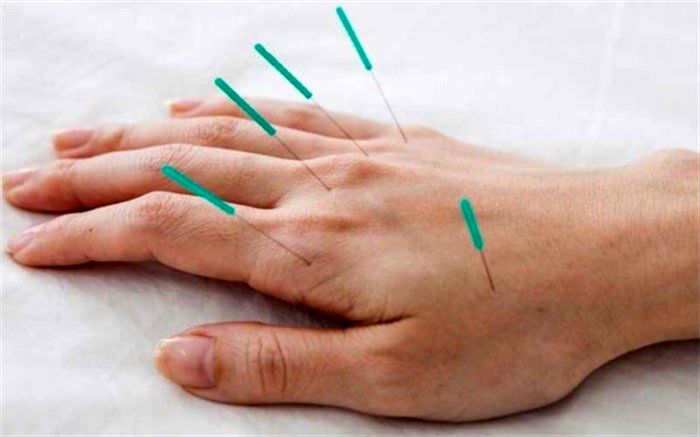 همه چیز درباره طب سوزنی در رادیو