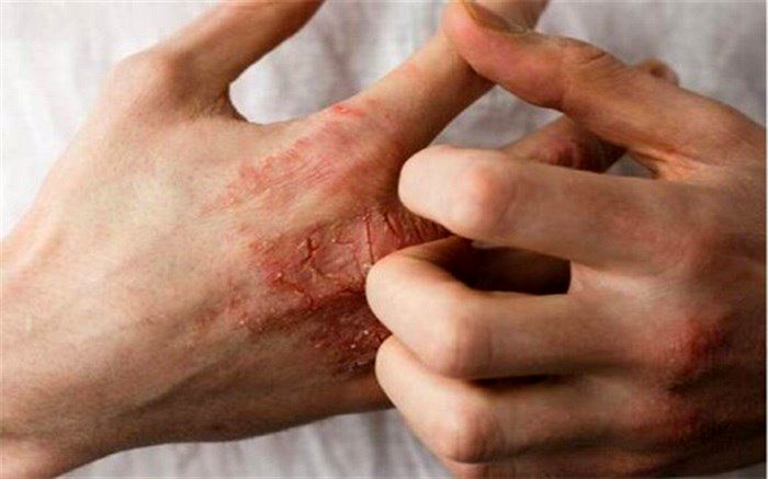 6 راهکار برای کاهش خشکی پوست در زمستان