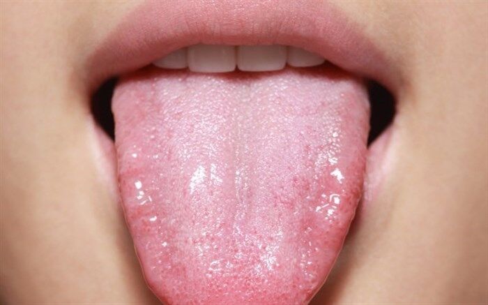 برفک دهان نشانه چیست؟