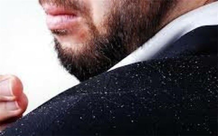 علائم بروز شوره سر