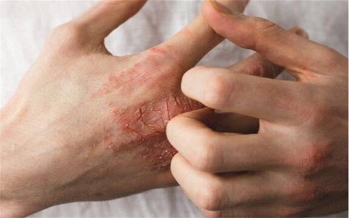 ‌خشکی پوست نشانه چه بیماری است؟